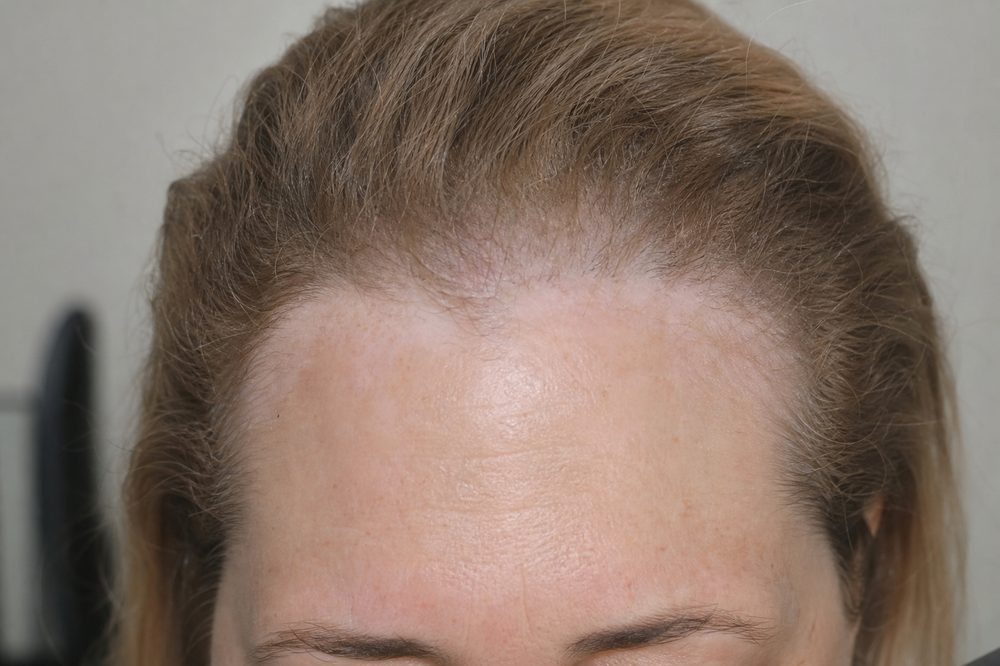 Alopécia frontal fibrosante